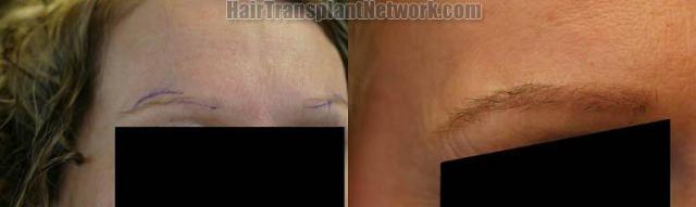 Eyebrow transplant surgery on female patient, shown from the 