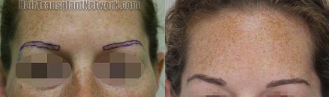 Eyebrow restoration procedure before and after results