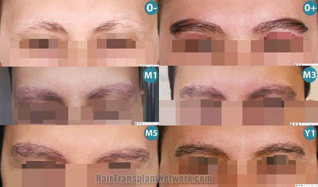 Front view - Before and after eyebrow restoration procedure