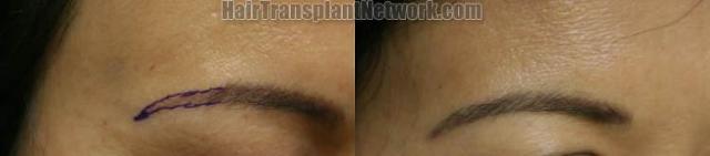 Female eyebrow transplant patient before and after