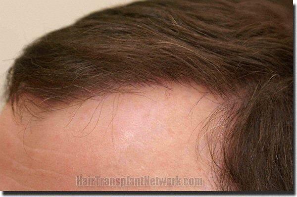 Hair restoration procedure results