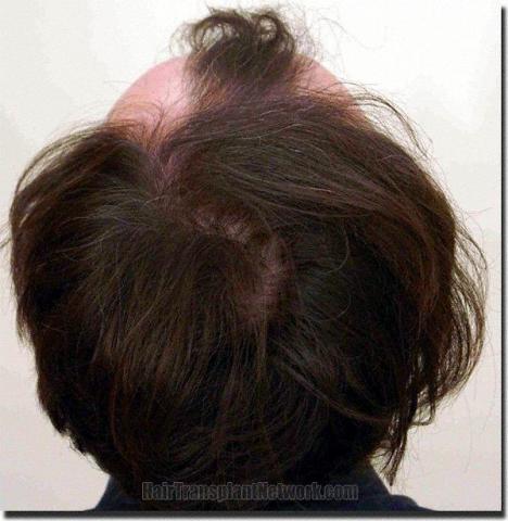 Hair restoration procedure results