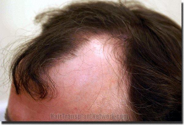 Hair restoration procedure results