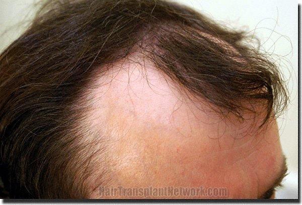 Hair restoration procedure results