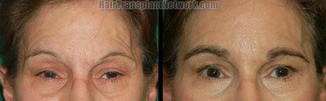 Eyebrow transplantation surgery before and after 