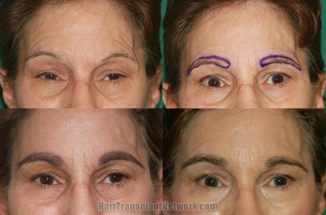  Before and after eyebrow restoration surgery
