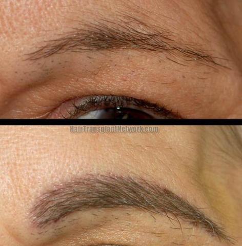 Eyebrow hair restoration procedure before and after