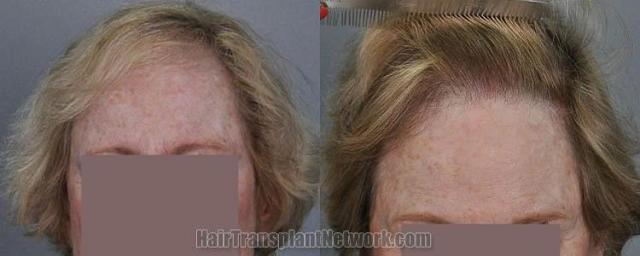 Female hair transplant surgery before and after photos