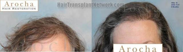 Female hair restoration procedure before and after