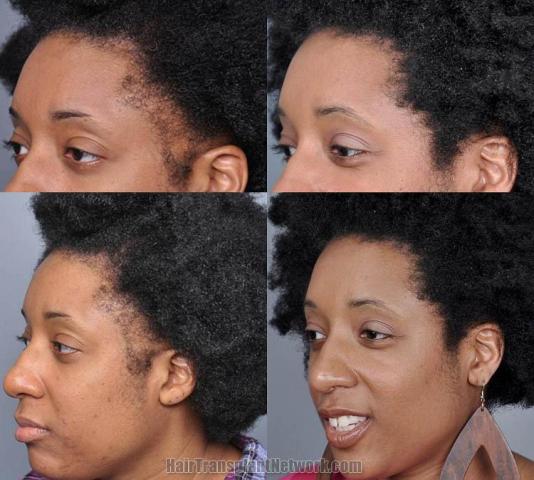 Hair restoration procedure before and after results