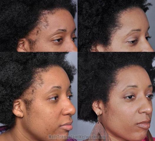 Before and after hair transplant procedure images