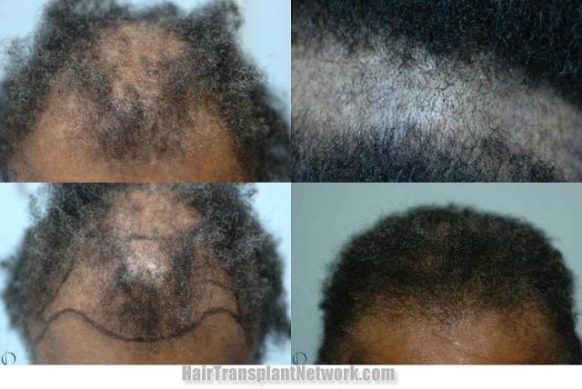 Hair transplantation surgery before and after images