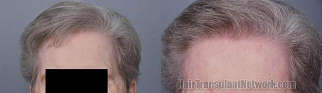 Female hair transplantation surgery before and after photos