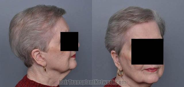 Hair restoration procedure before and after pictures