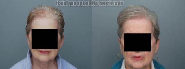 Female  before and after photos