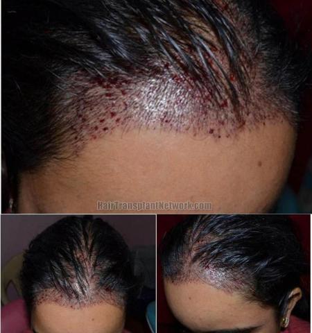 Female hair transplantation surgery before and after pictures
