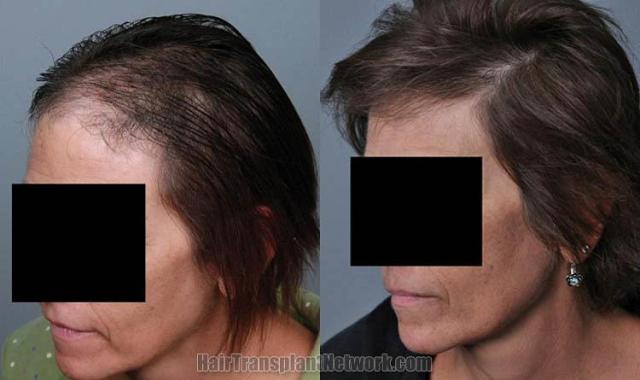 Hair transplantation surgery before and after images