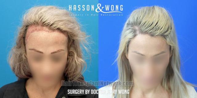 Female hair transplantation surgery before and after images