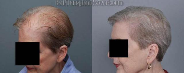 Hair restoration procedure results