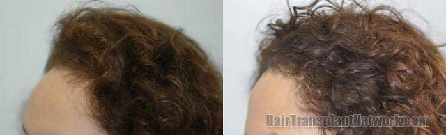 Hair restoration procedure results