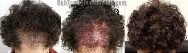 Female hair transplant before and after pictures