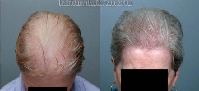 Top view before and after female hair restoration images