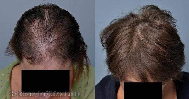 Before and after hair transplant procedure images