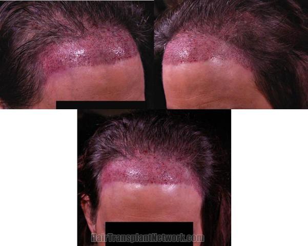 Hair transplantation surgery before and after pictures