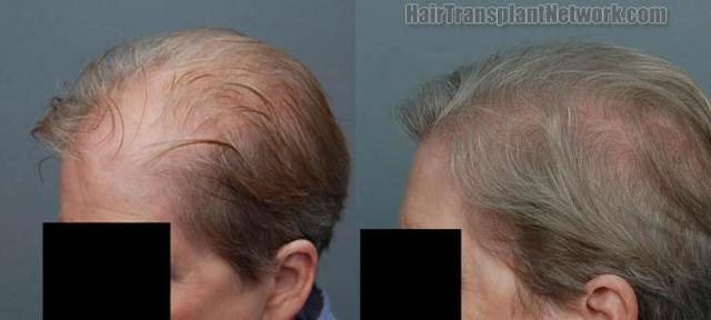 Left view before and after hair transplantation on female