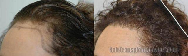 Right view - female hair transplant procedure pictures