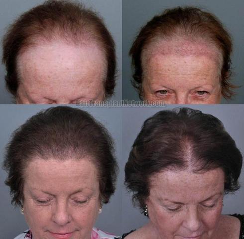 Hair restoration procedure before and after results