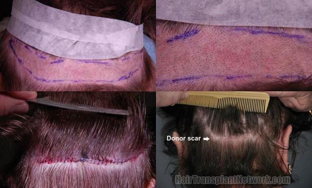 Hair transplantation surgery before and after pictures