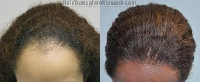 Female - top view before and after hair restoration results