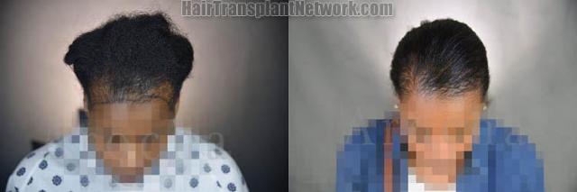 Female hair transplantation surgery before and after images