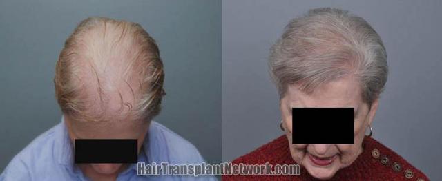 Hair restoration procedure before and after results