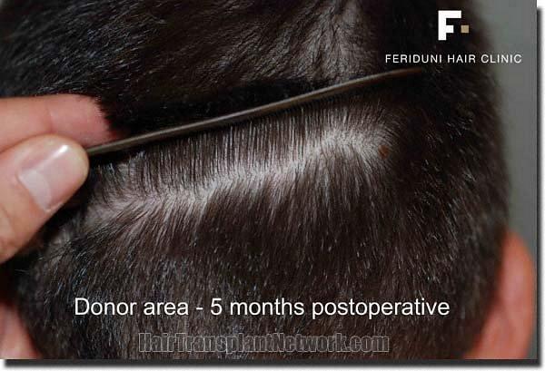 Hair restoration procedure results