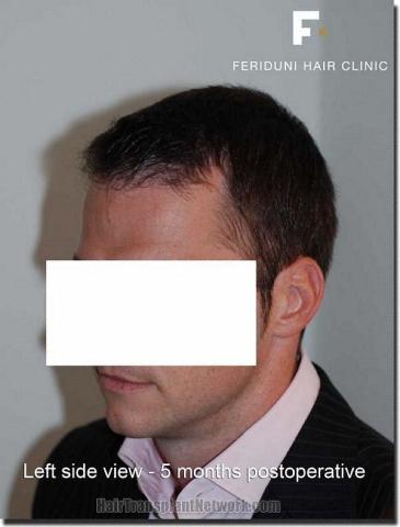 Hair restoration procedure results