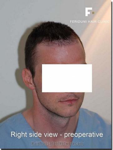 Hair restoration procedure results