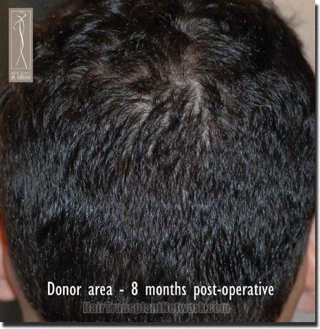 Hair restoration procedure results