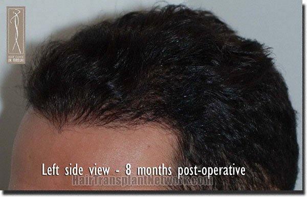 Hair restoration procedure results