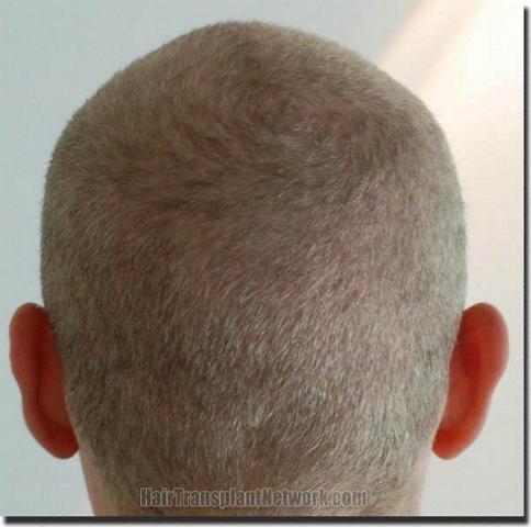 Hair restoration procedure results