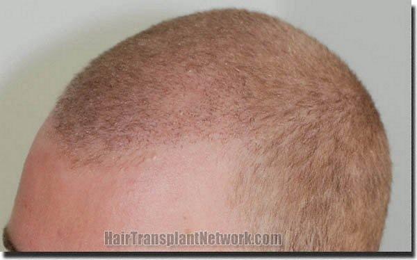 Hair restoration procedure results