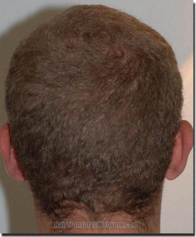 Hair restoration procedure results