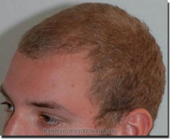 Hair restoration procedure results