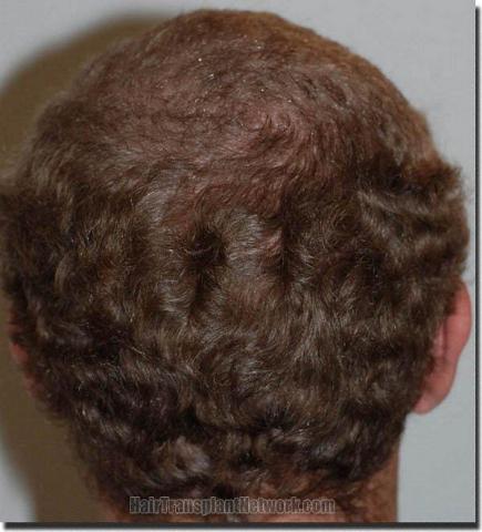 Hair restoration procedure results