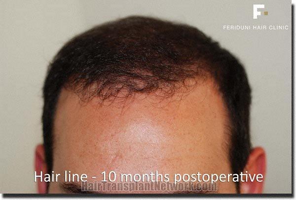 Hair restoration procedure results