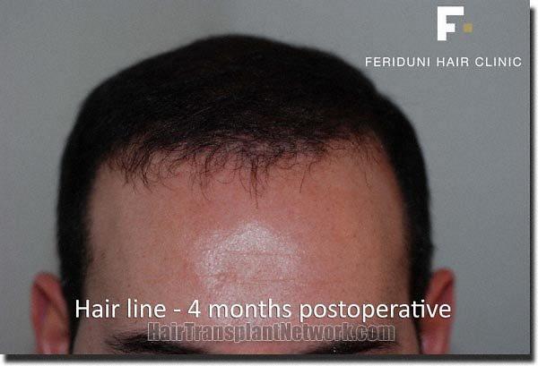 Hair restoration procedure results