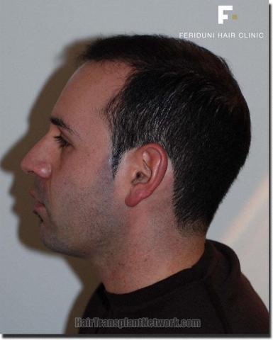 Hair restoration procedure results