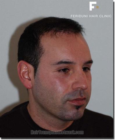 Hair restoration procedure results