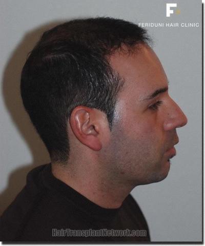 Hair restoration procedure results